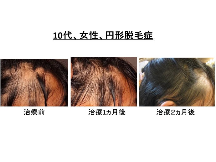 円形脱毛症　病院""